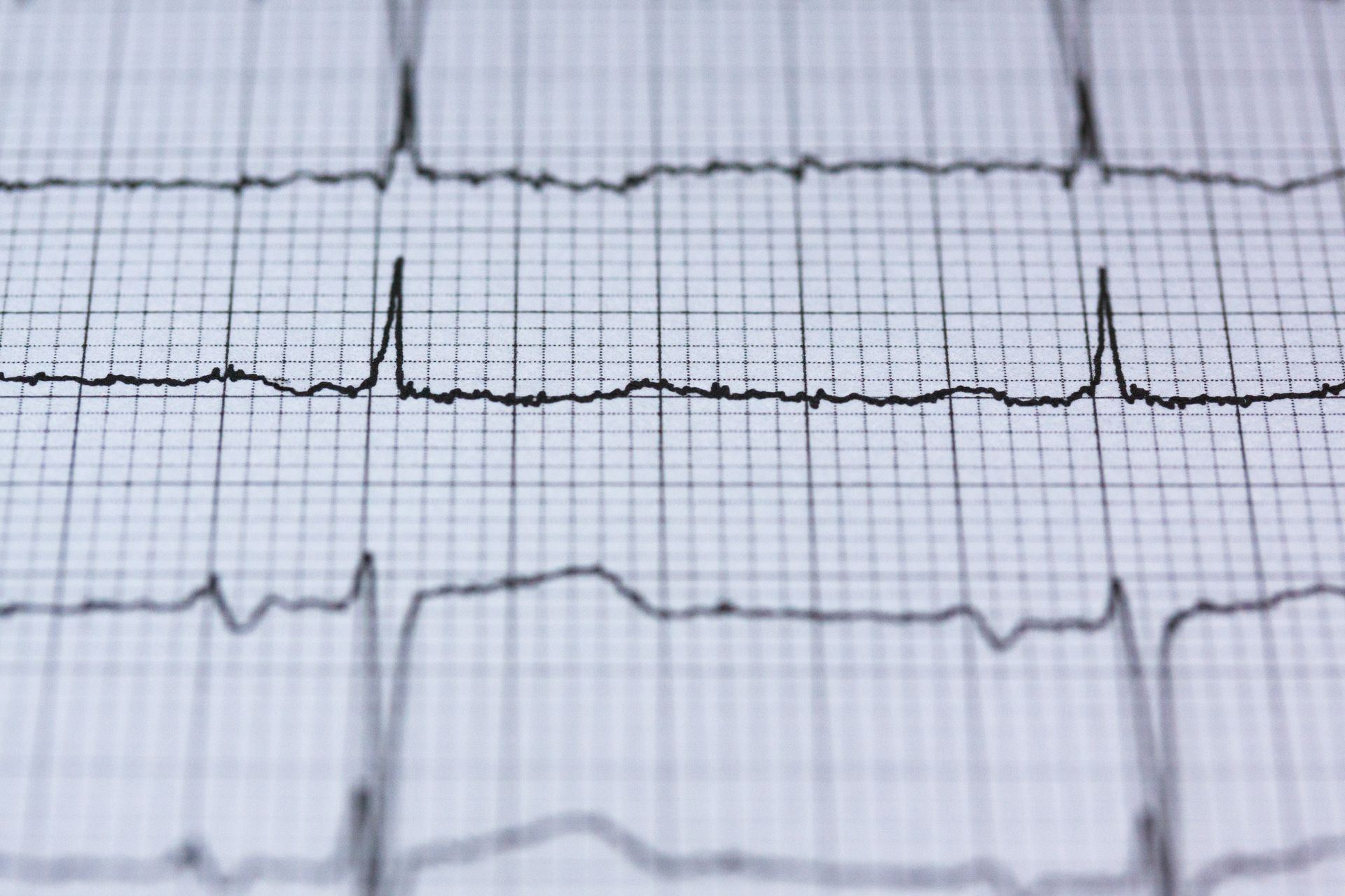 Close-up of an ECG tracing on graph paper