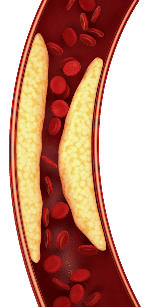High cholesterol effect on arteries.