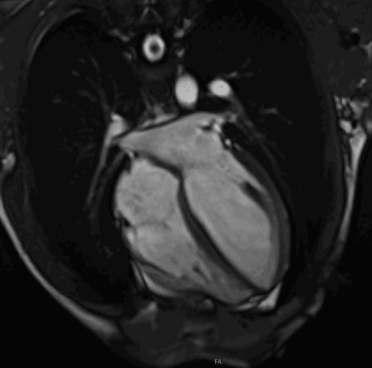 MRI scan of a human heart