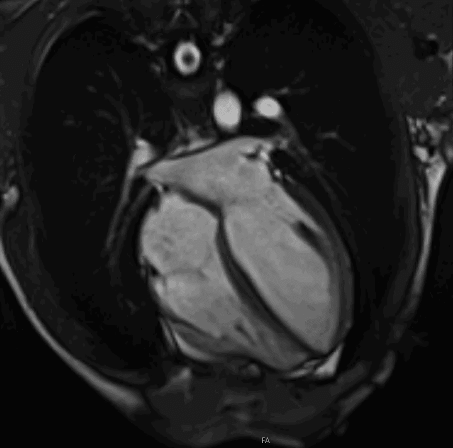 MRI scan of a human heart