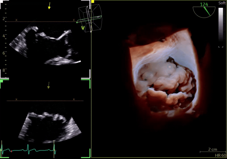 Ultrasound images of the mitral valve.