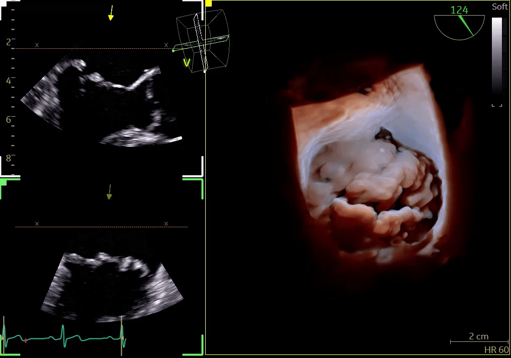 Ultrasound images of the mitral valve.