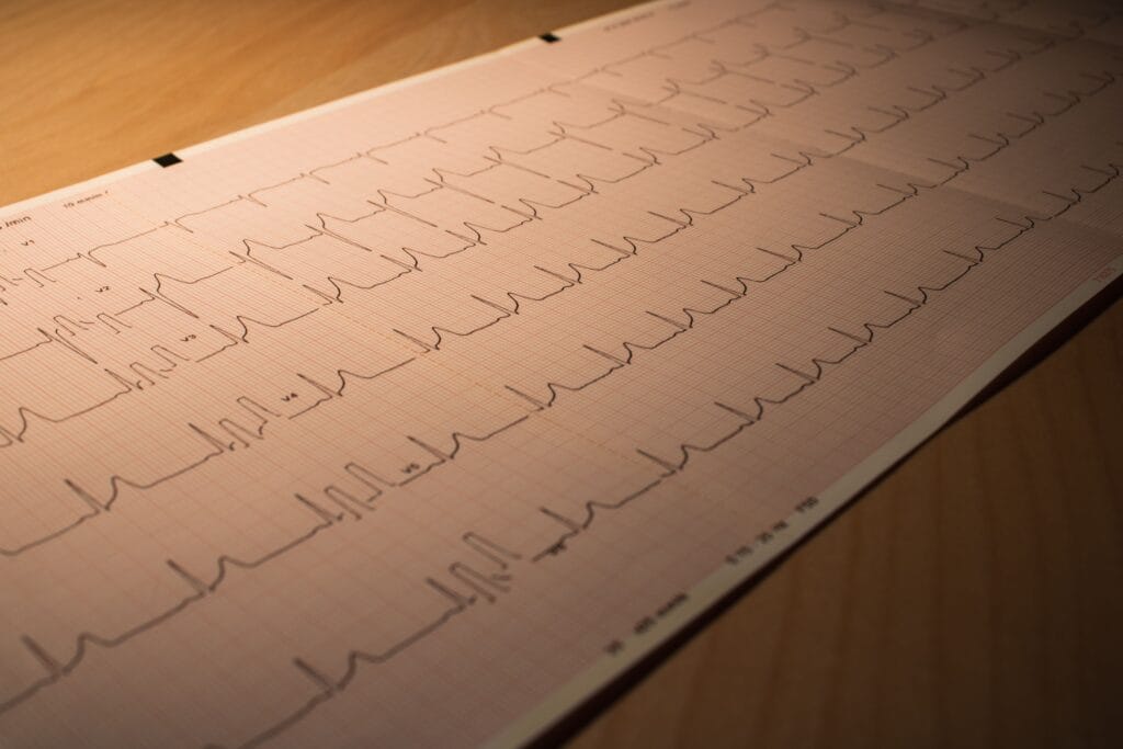 ECG tracing used in assessment of palpitations and irregular heartbeat.