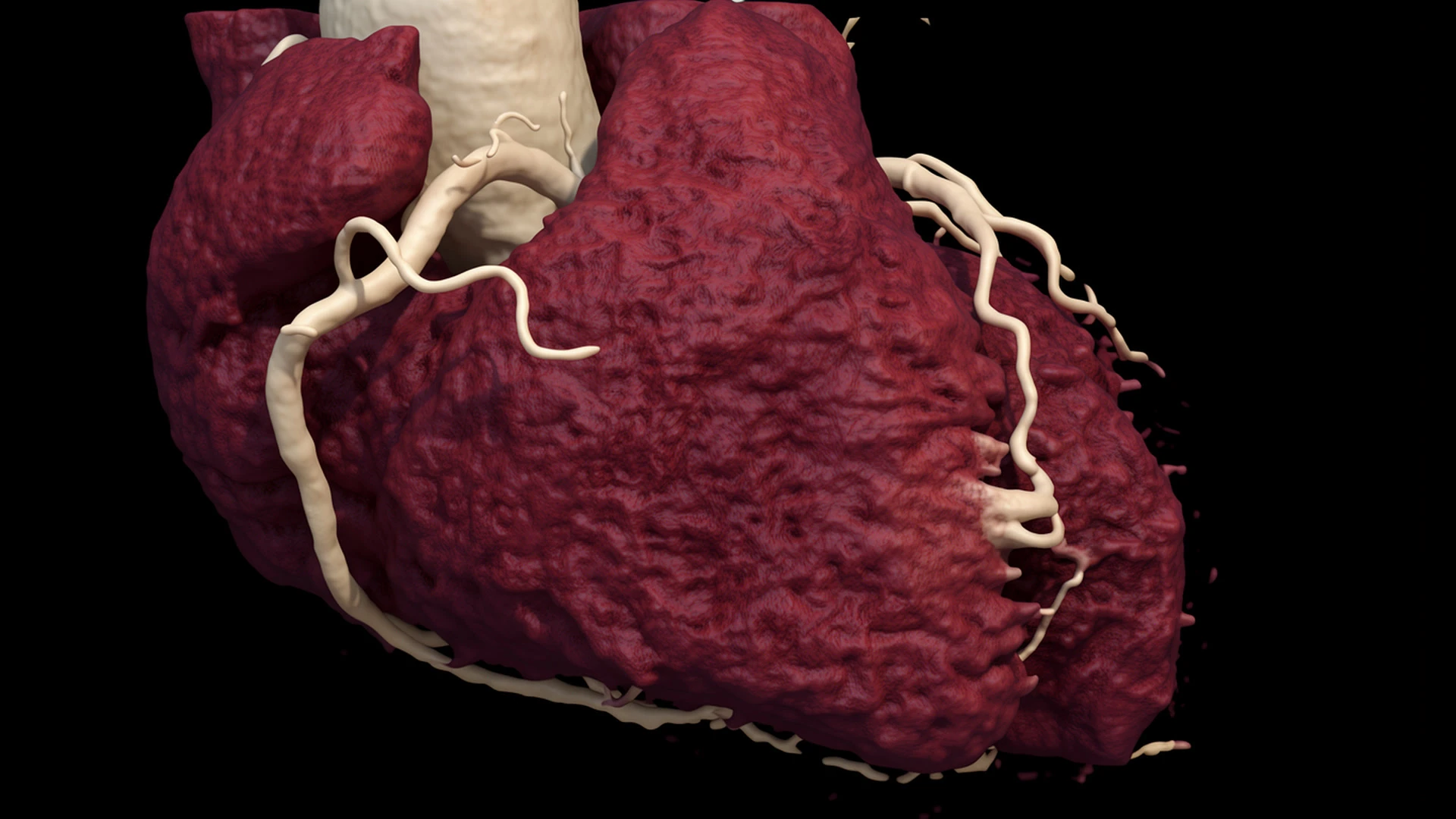 Three-dimensional cardiac CT reconstruction showing the coronary arteries on the surface of the heart